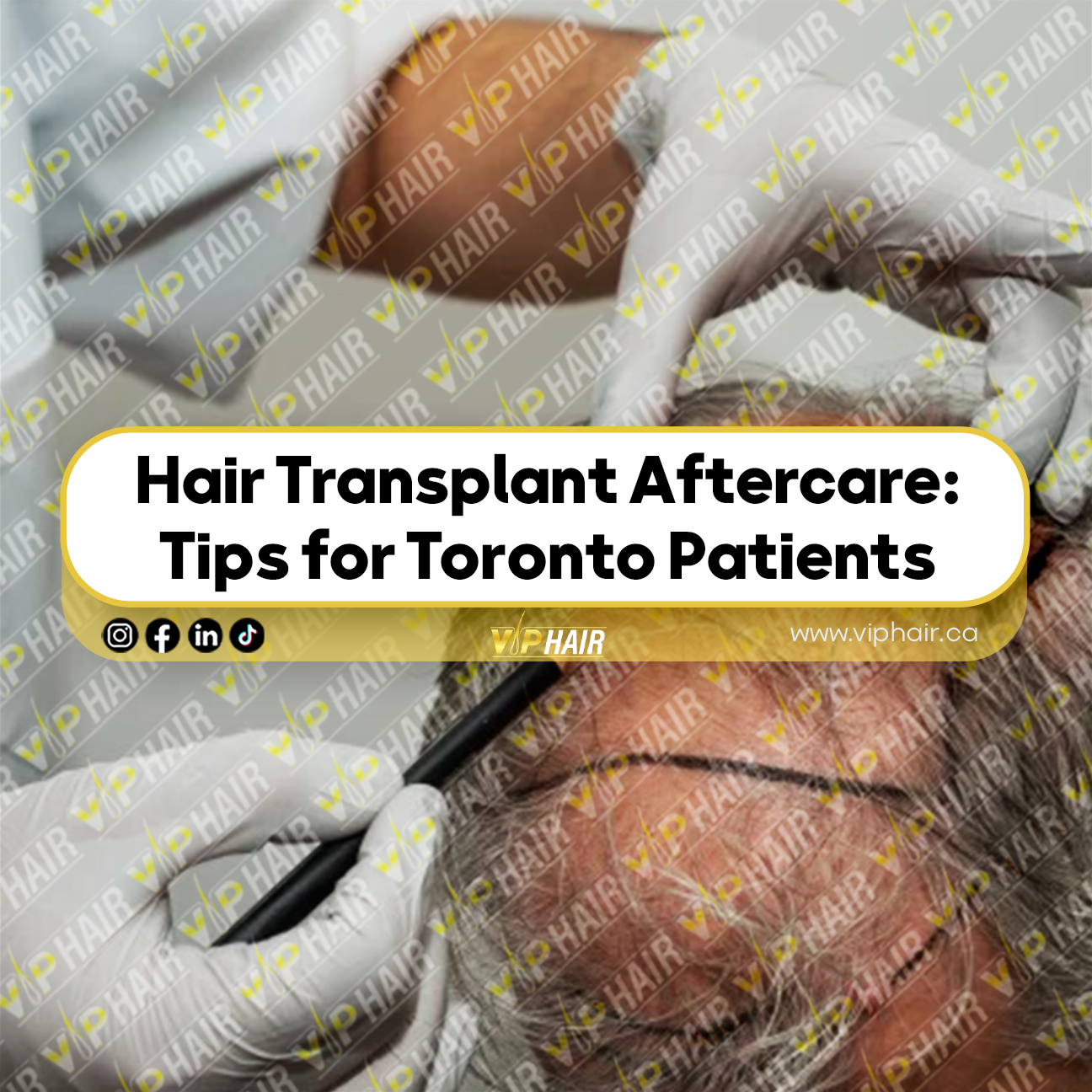 Hair Transplant Aftercare Tips-for-Toronto-Patients