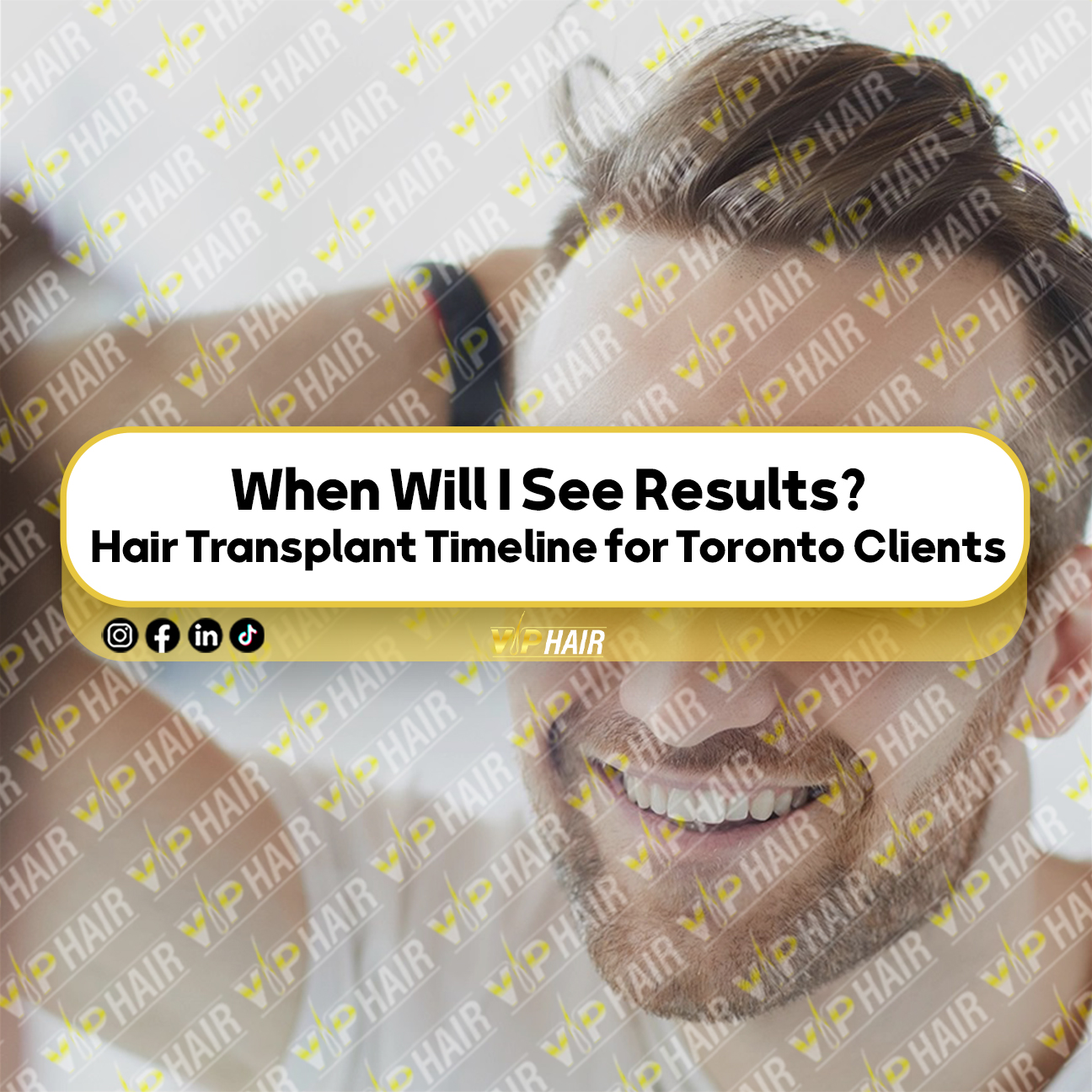 Hair Transplant Timeline for Toronto Clients