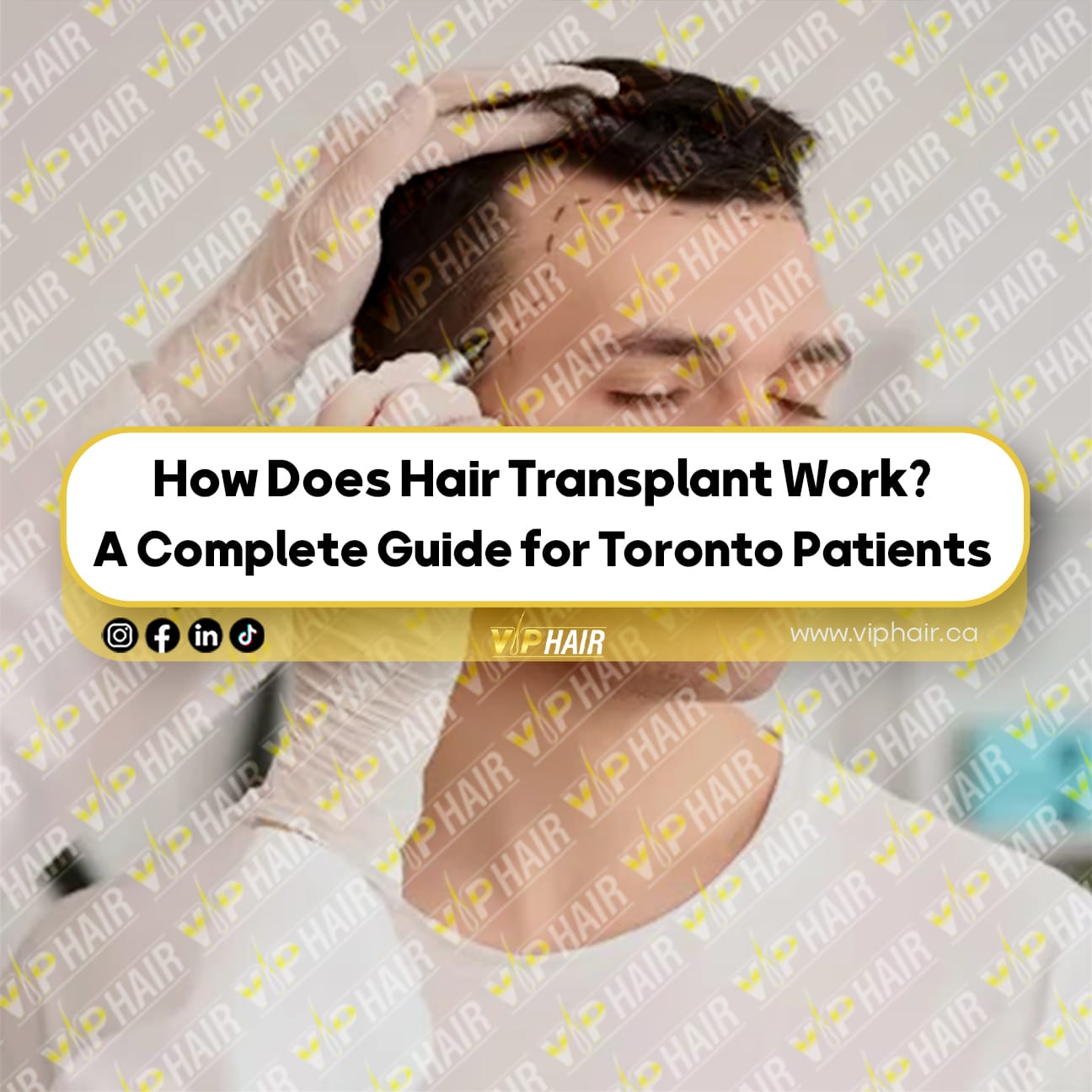 How-Does-Hair-Transplant-Work--A-Complete-Guide-for-Toronto-Patients