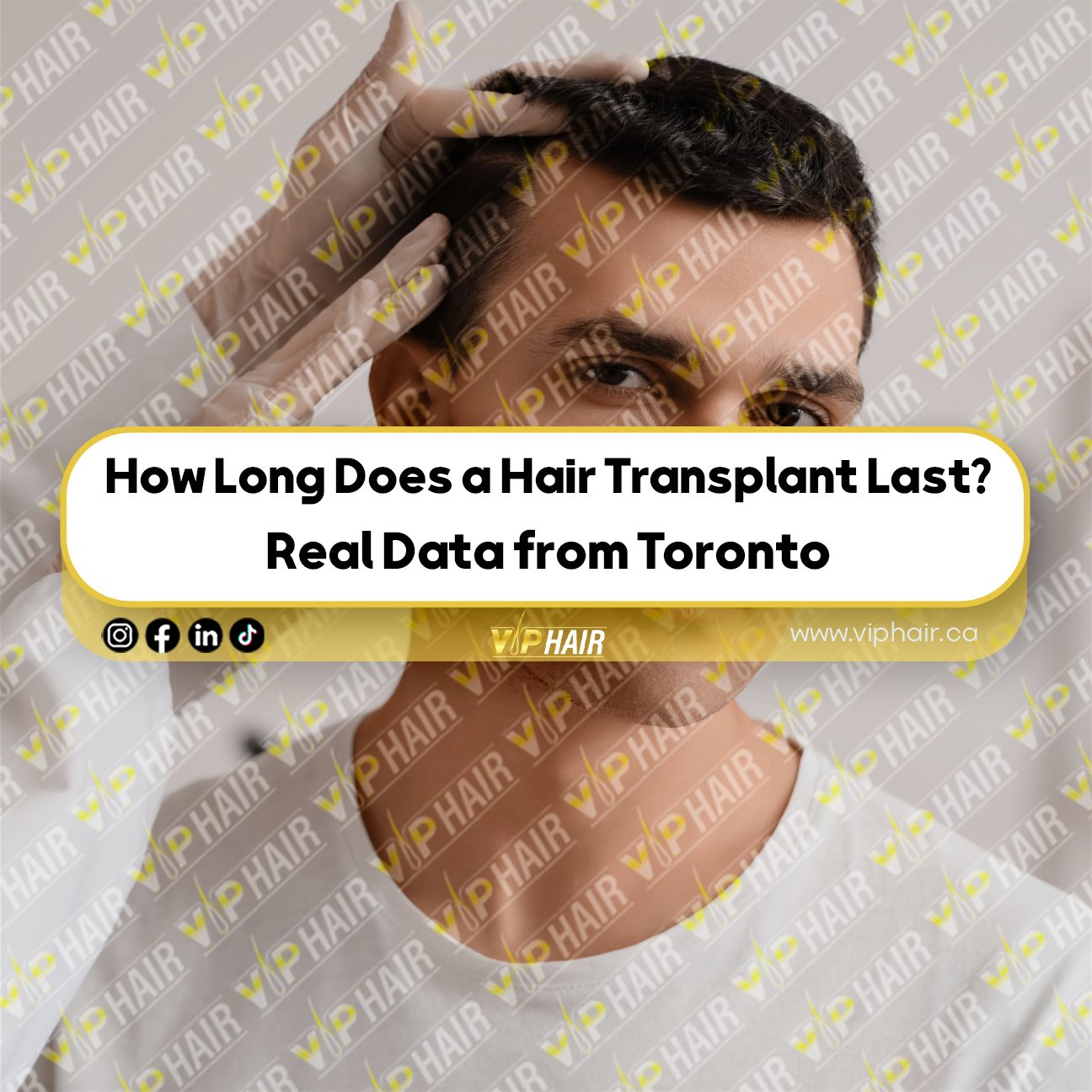 How-Long-Does-a Hair Transplant-Last--Real-Data-from-Toronto