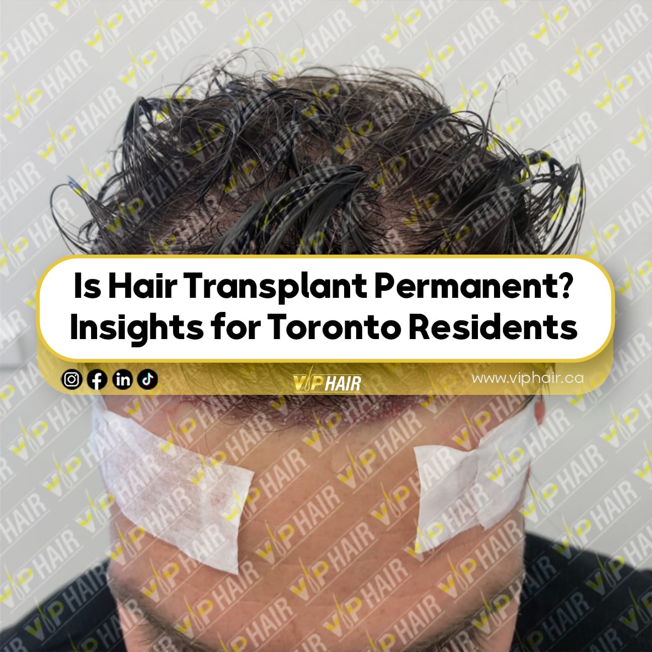 Is-Hair Transplant Permanent--Insights-for-Toronto-Residents