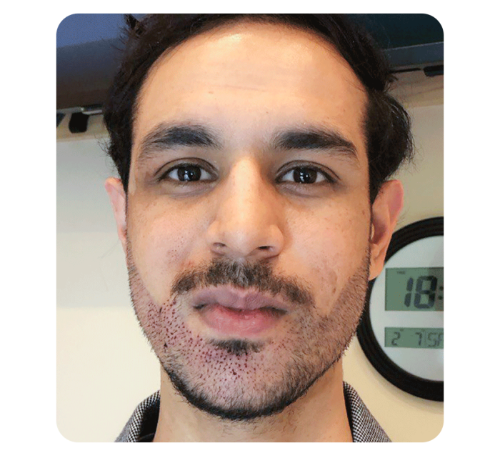 Beard Transplant Toronto - Image 3
