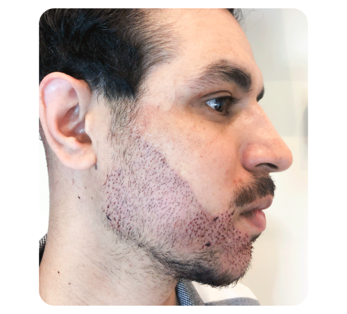 Beard Transplant Toronto