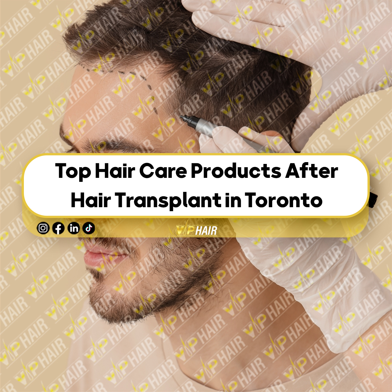 Top Hair Care Products After Hair Transplant in Toronto