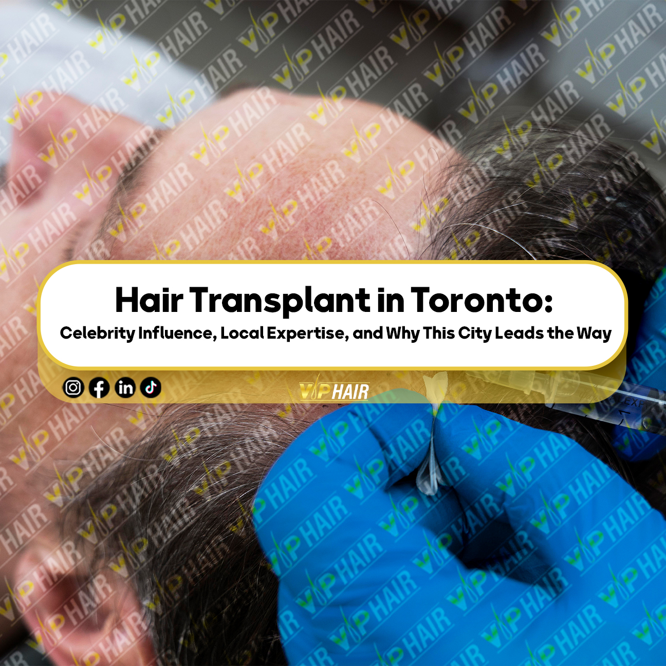 Hair-Transplant-in-Toronto-Celebrity-Influence,-Local-Expertise,-and-Why-This-City-Leads-the-Way