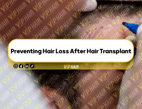 Preventing Hair Loss After Hair Transplant