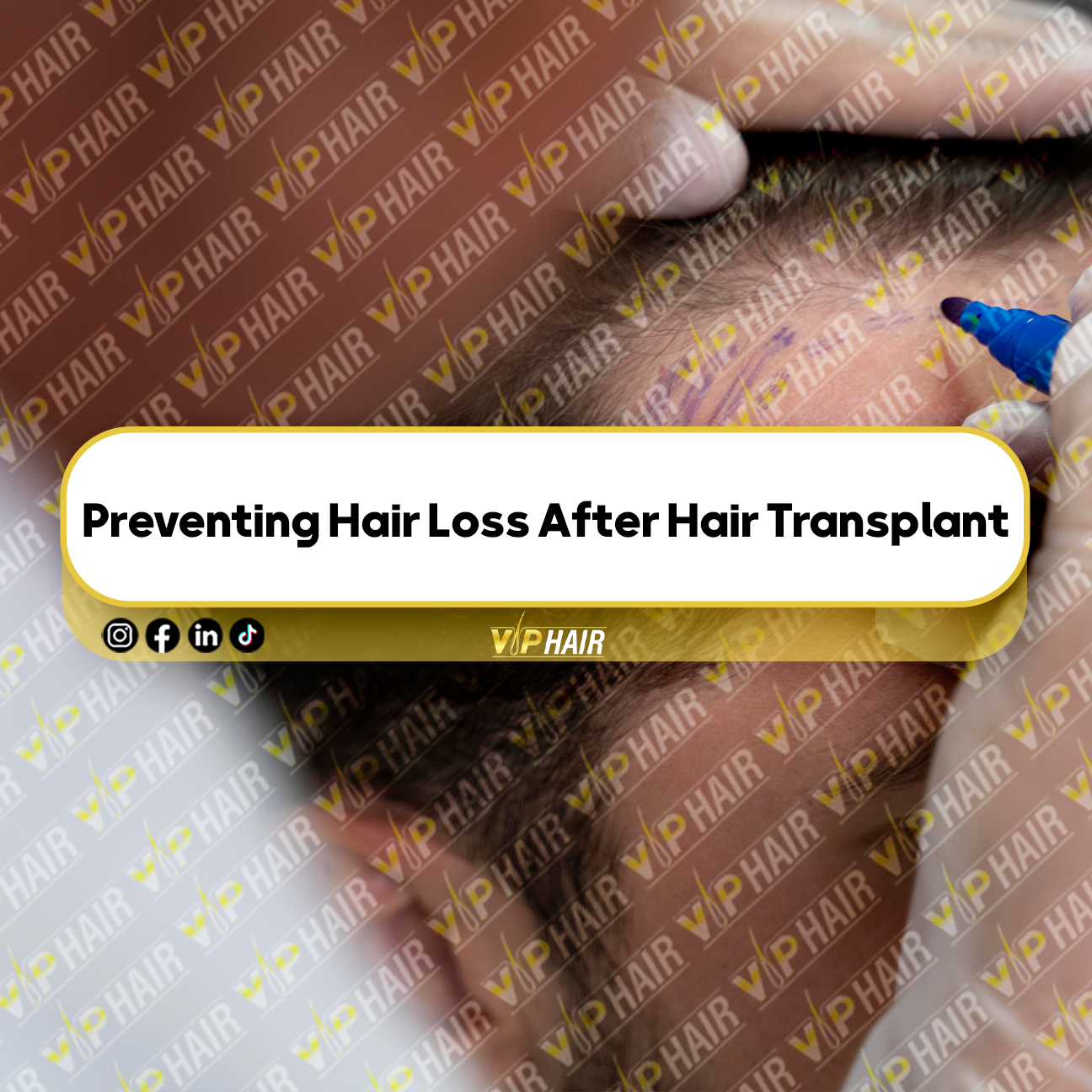 Preventing-Hair-Loss-After-Hair-Transplant