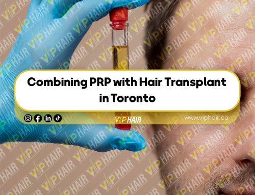 Combining PRP with Hair Transplant in Toronto: Why It Matters