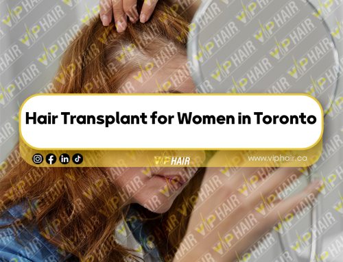 Hair Transplant for Women in Toronto: Is It Right for You?