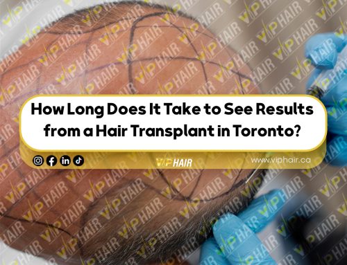 How Long Does It Take to See Results from a Hair Transplant in Toronto?