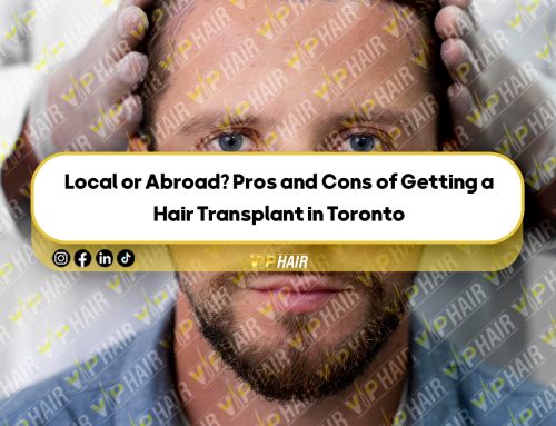 Local or Abroad? Pros and Cons of Getting a Hair Transplant in Toronto