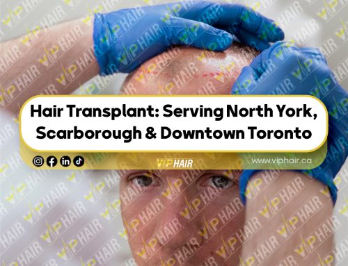 Hair Transplant: Serving North York, Scarborough & Downtown Toronto