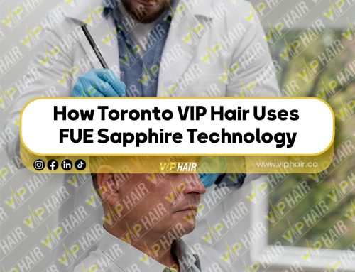 How Toronto VIP Hair Uses FUE Sapphire Technology