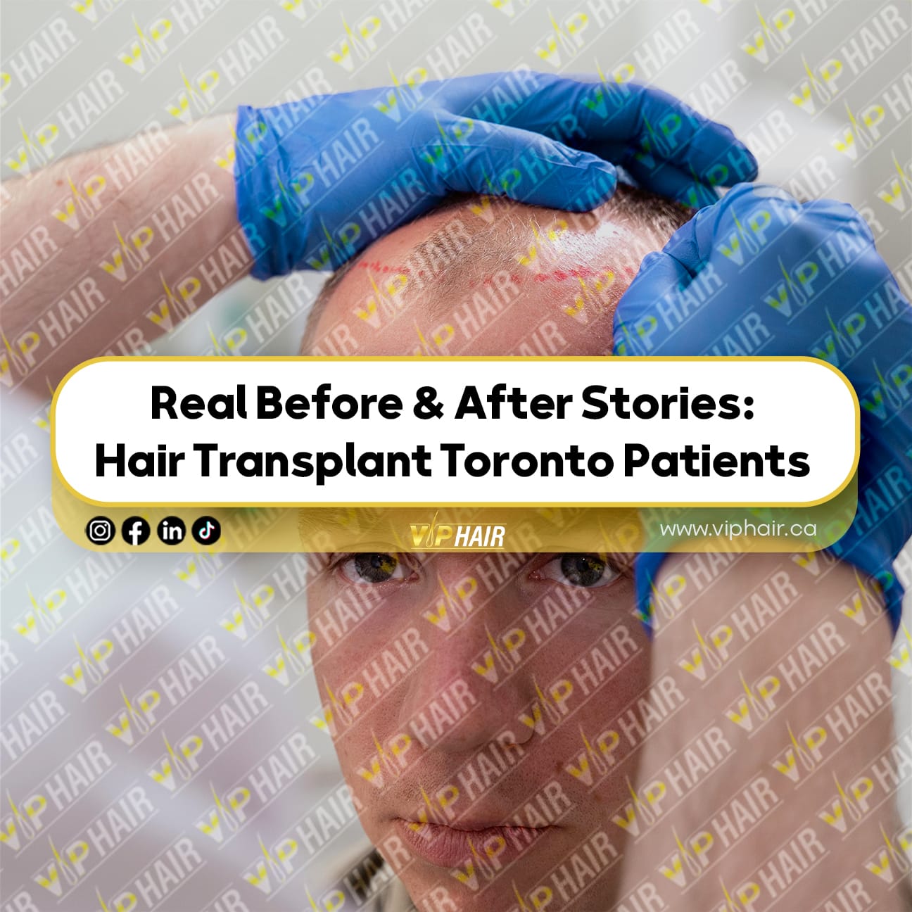 Real-Before-&-After-Stories--Hair-Transplant-Toronto-Patients